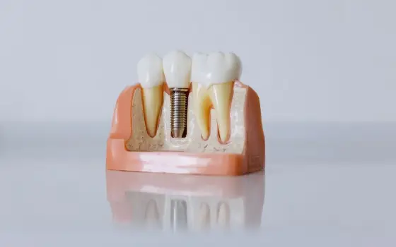 Dental implant model